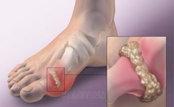 Bệnh gout gây sưng đau các khớp