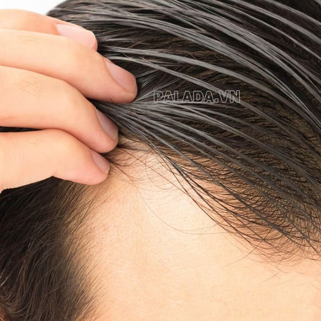Hiện tượng tóc bết gây mất thẩm mỹ và tiềm ẩn nhiều nguy cơ bệnh lý