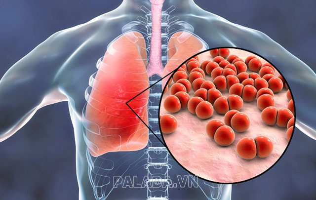 Viêm phổi cũng gây đau nhức cơ